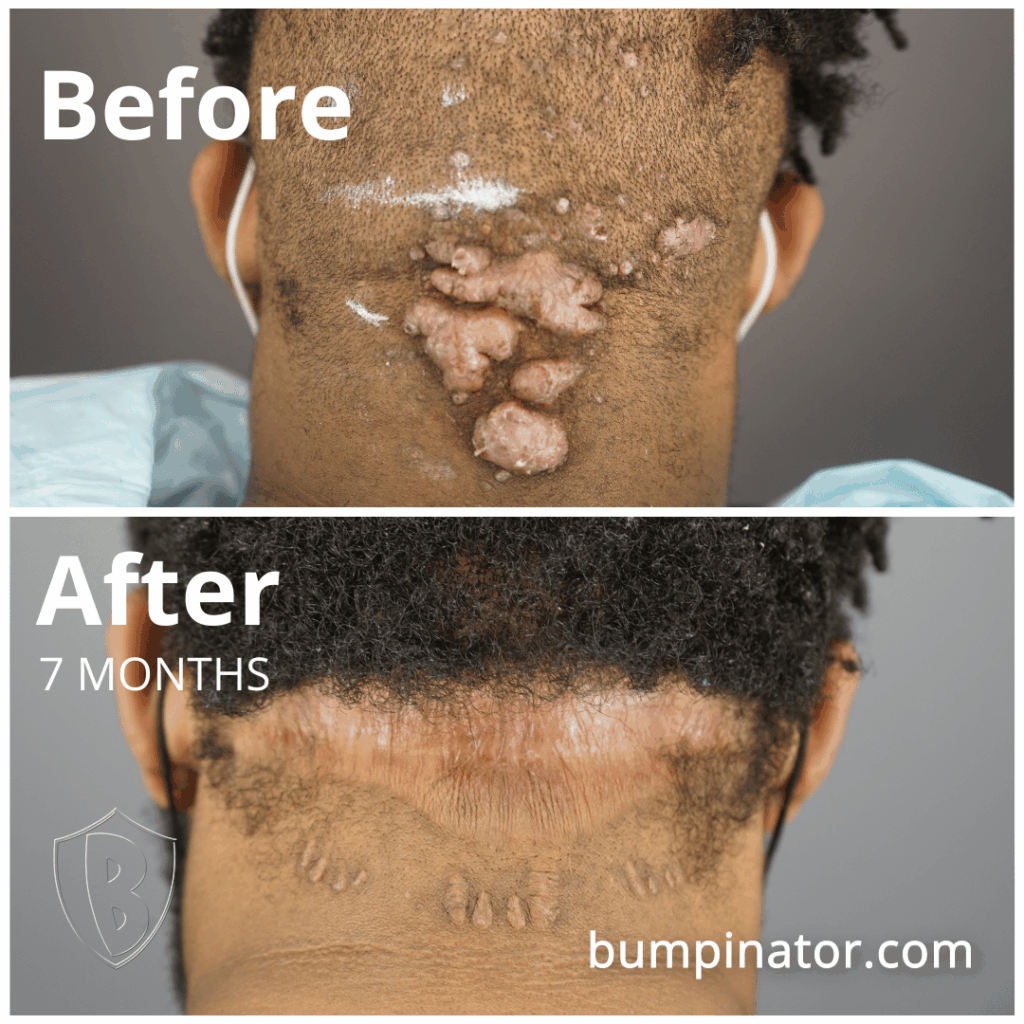 AKN Bump Removal Results - Acne Keloidalis Nuchae Bumps Removal Surgery