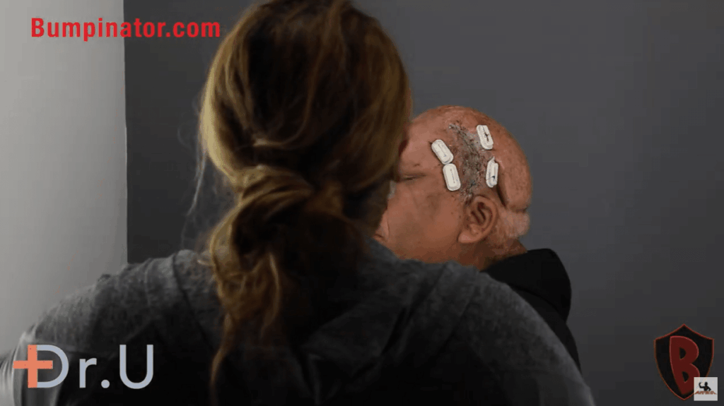 Athena Tension Sutures - Robert Peeters Post Surgery with Sutures in place.
