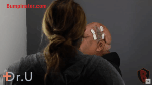 Athena Tension Sutures - Robert Peeters Post Surgery with Sutures in place.