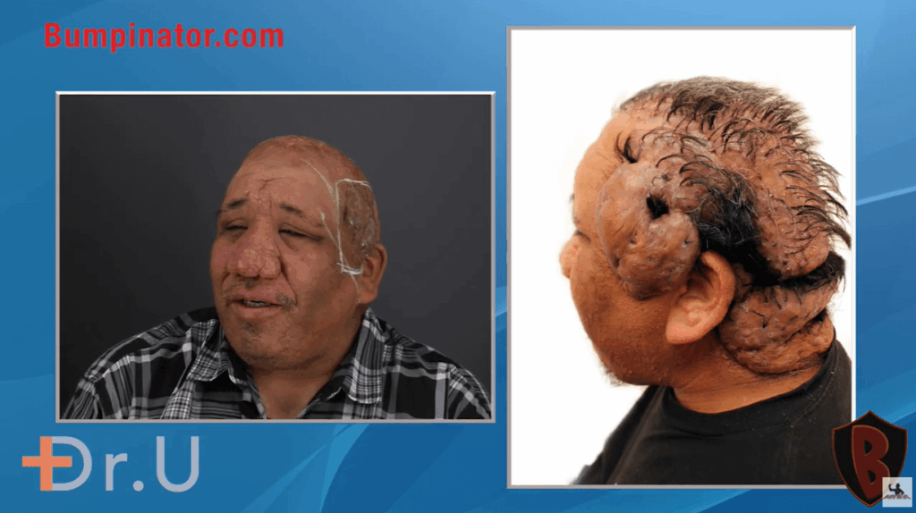 Bob's Recovery Pt. 2 Video Thumbnail V1 - AKN Removal results, Dr. U Skin & Hair Clinic - Dr. Sanusi Umar AKA The Bumpinator.