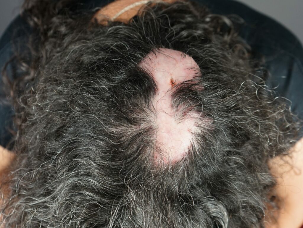 Example of Folliculitis Decalvans (FD) Patient #1 - Dr. U Skin & Hair Clinic, The Bumpinator