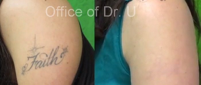 Laser tattoo removal final before and after results - Dr. U Skin & Hair Clinic*