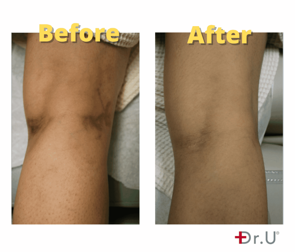 Leg Vein Laser Removal Before & After Results - Dr. U Skin & Hair Clinic, Manhattan Beach, CA*
