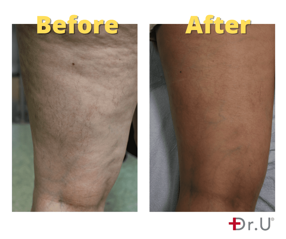 Leg Vein Removal Before & After Results V1 - Dr. U Skin & Hair Clinic Los Angeles CA