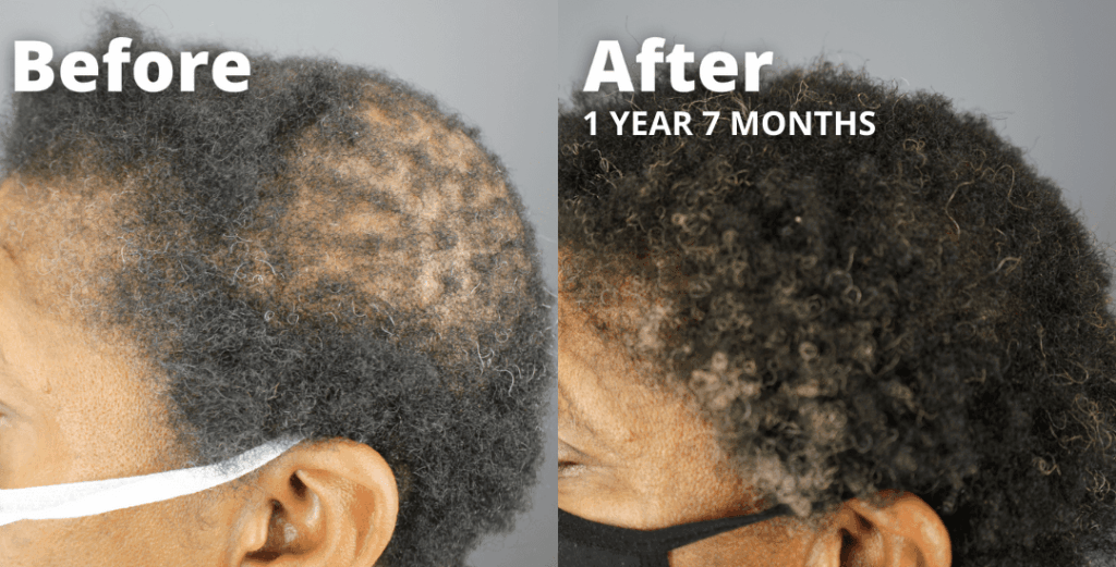 CCCA Patient Treated Using GASHEE - Natural Hair Growth Results V2*