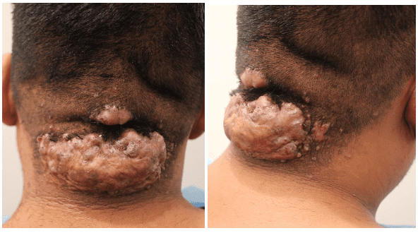 The AKN patient had two lesions and many small bumps, which he wanted to be removed by Dr. Umar. *