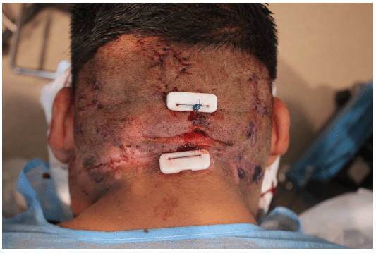 Dr. Umar, AKA the Bumpinator, used the Athena sutures he invented to remove the AKN plaques successfully.*