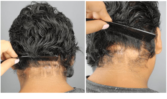 Only 9  months post-surgery, the patient’s scar is already looking much better. *