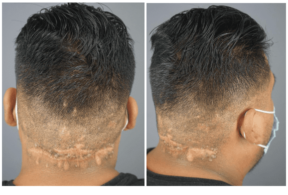 1 year and 8 months after his removal surgery, and the scar is healing so well, the patient feels comfortable enough to have a short haircut. *