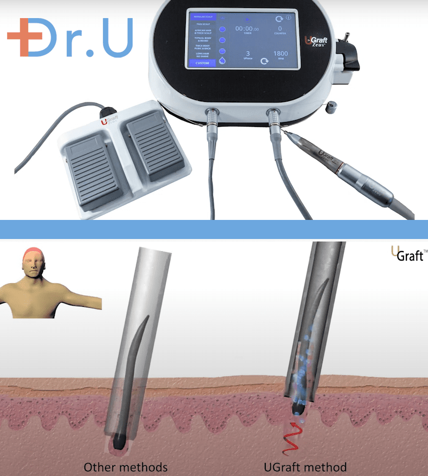 The Advanced Dr.UGraft FUE method created and used by Dr. Sanusi Umar. The Advanced Dr.UGraft FUE method created and used by Dr. Sanusi Umar.