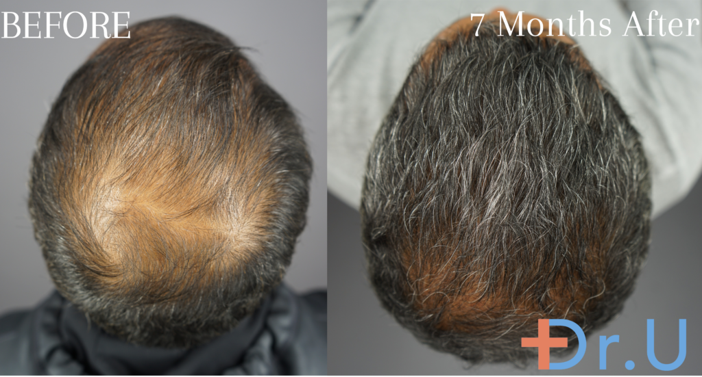 hairline restoration for a 29 years old male patient.