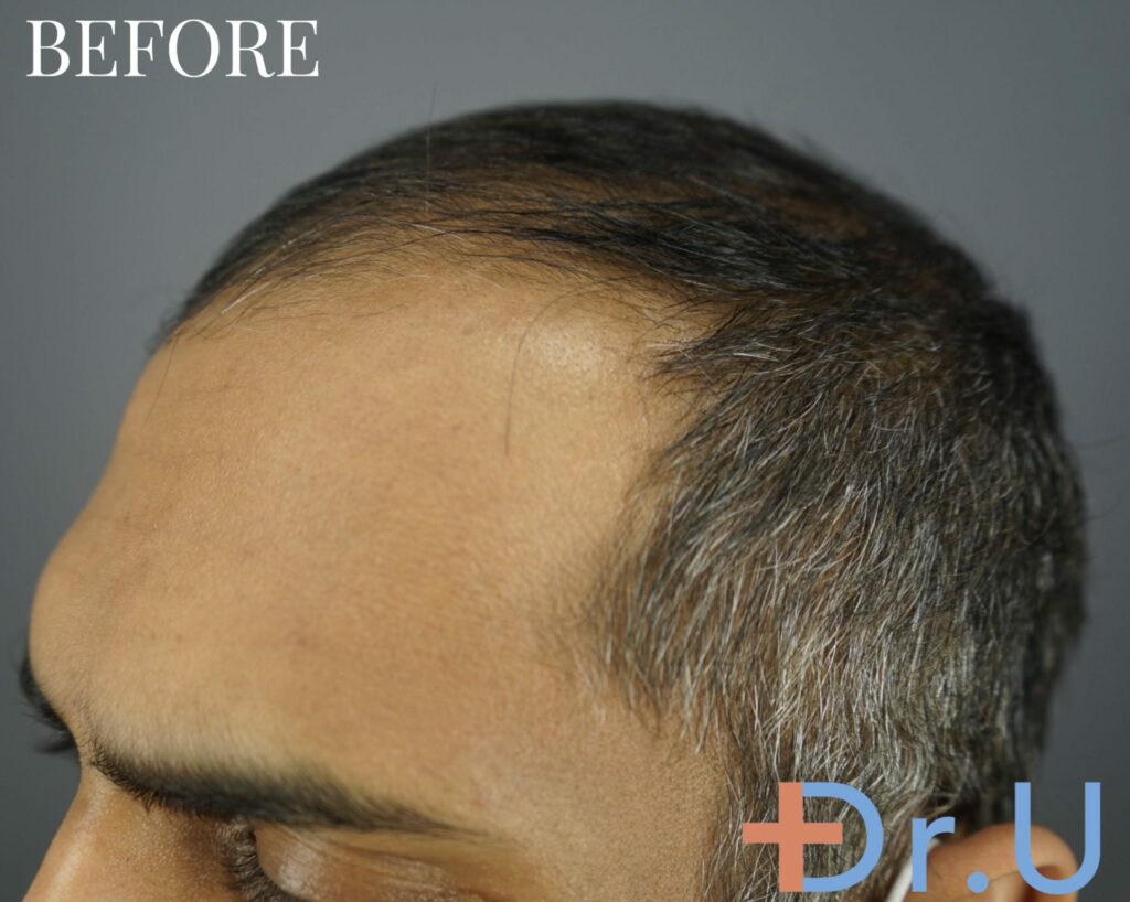 hairline restoration for a 29 years old male patient.