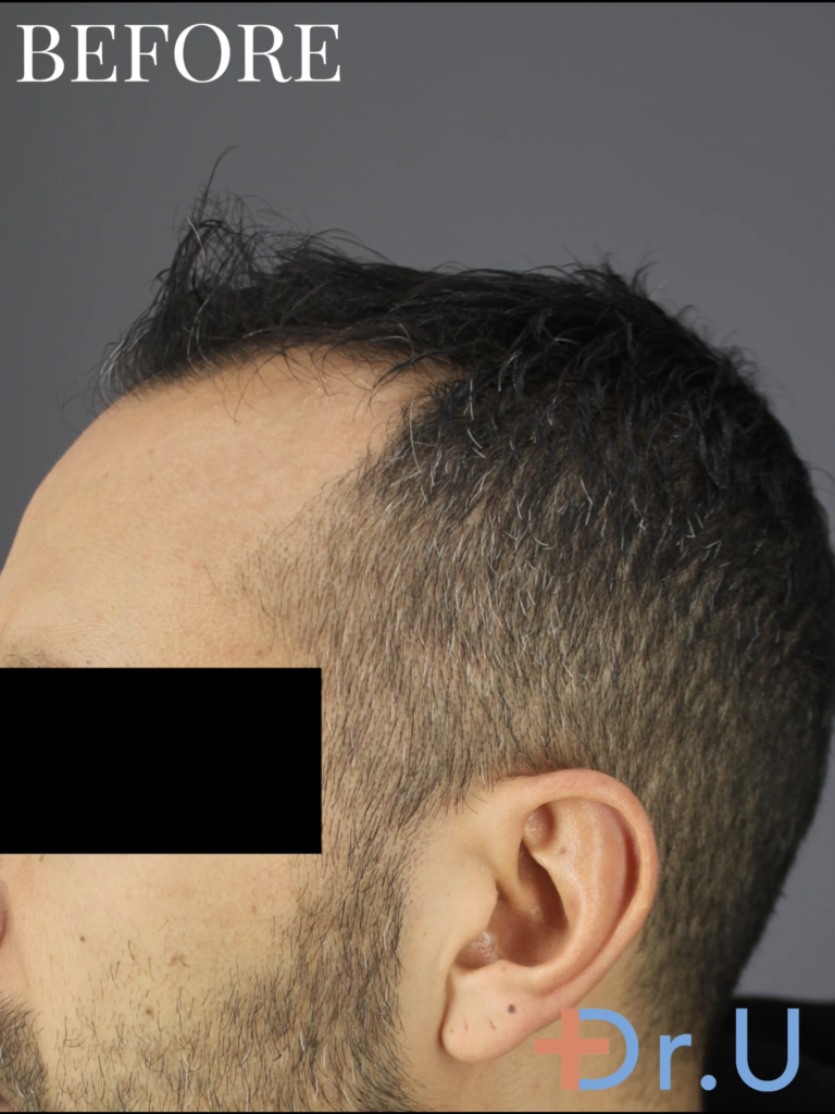 the patient need to restore hair in his hairline and mid-scalp. the patient need to restore hair in his hairline and mid-scalp.