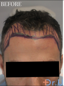 Dr. Umar drew the patient's hairline before starting the surgery.* Dr. Umar drew the patient's hairline before starting the surgery.*