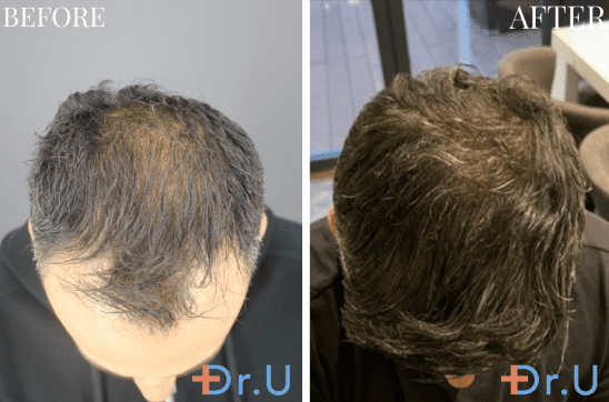 The young man left Dr. U Hair and Skin Clinic with a renewed sense of confidence. The young man left Dr. U Hair and Skin Clinic with a renewed sense of confidence.