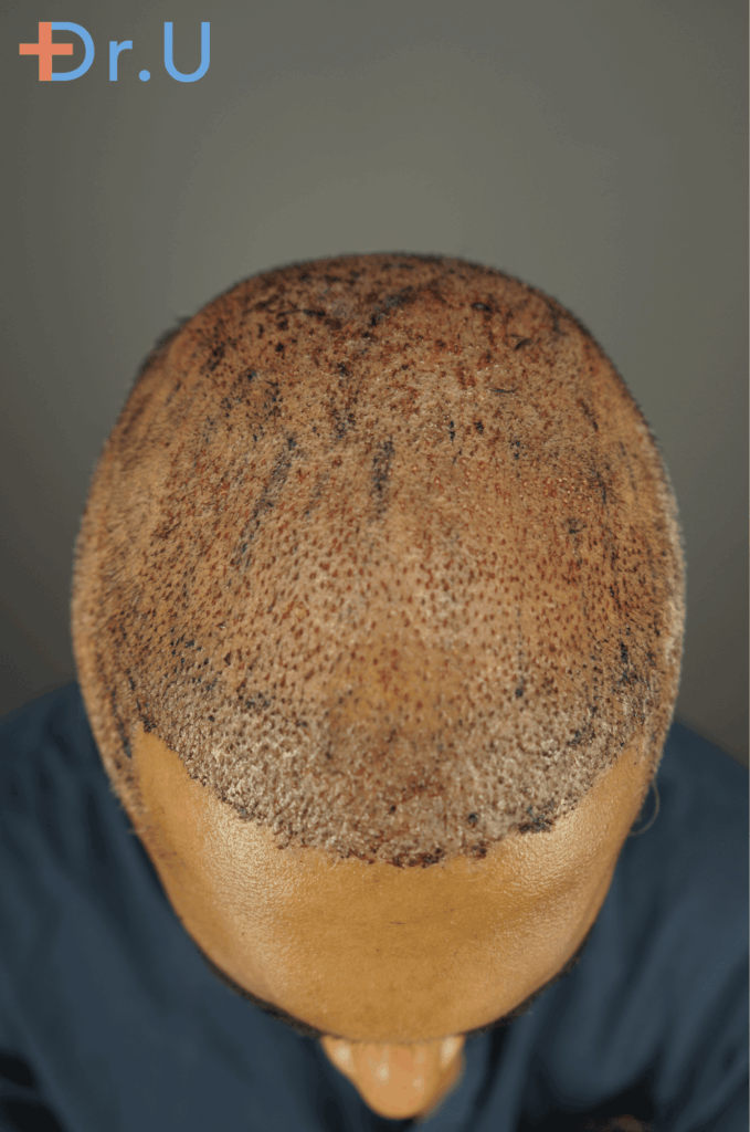 hairline restoration for a 29 years old male patient.