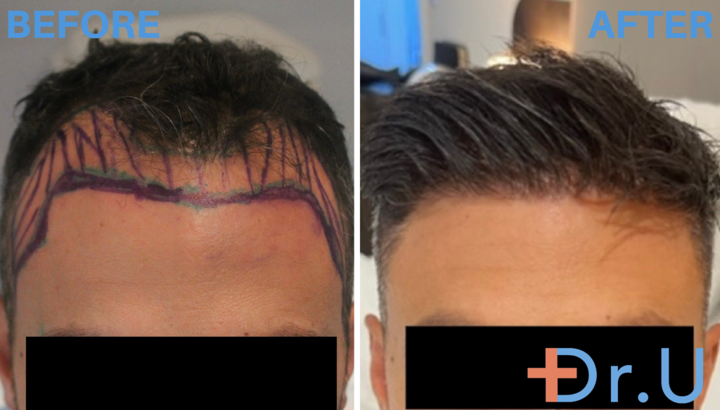 The young man left Dr. U Hair and Skin Clinic with a renewed sense of confidence after his hair restoration surgery. The young man left Dr. U Hair and Skin Clinic with a renewed sense of confidence after his hair restoration surgery.