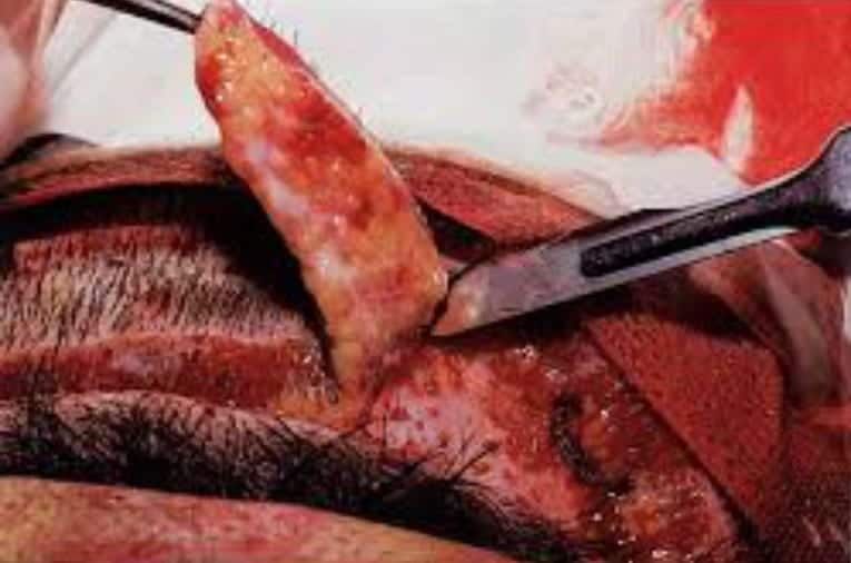 FUT strip harvesting is in progress. A strip of hair-bearing scalp is surgically removed. All the transplanted hair would be derived from this strip of flesh. FUT is sometimes called Follicular Unit Strip Surgery (FUSS).