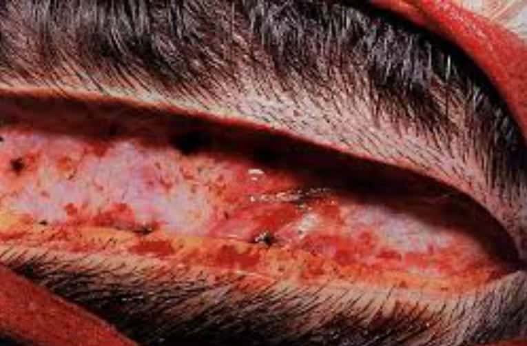 After the excision of a strip of the scalp in FUT, A horizontal strip of open wound is left behind. This is then sewn up by the surgeon to leave a linear scar