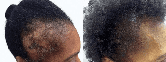 The Afro-Brazilian woman had temple hair loss from advanced traction alopecia. Her results are seen 7 month after her FUE hair transplant surgery with the UGraft Zeus.