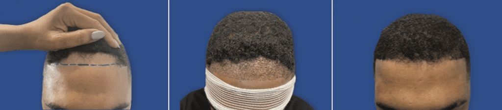 An African-American man with hairline recession (left), immediately after FUE hair transplant surgery with the UGraft Zeus (center), and 10 months post-surgery (right).*