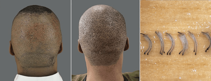 An African-American man, with thick, firm skin, mild acne keloidalis nuchae, and coily hair pre-surgery (left), 1 year post-surgery (center), and extraced hair grafts (right).*