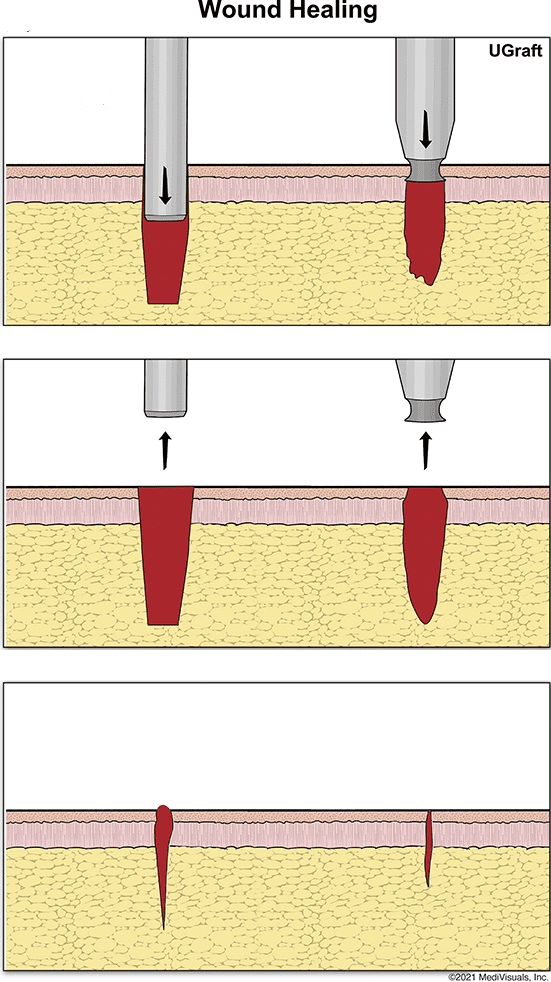 On the left, wounding and healing with a traditional FUE punch. On the right, wounding and healing with the UGraft Zeus.