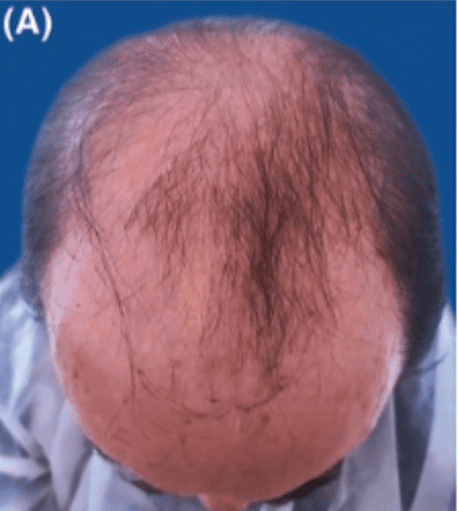 The patient was suffering from NW VI-VII male pattern baldness (MPB).