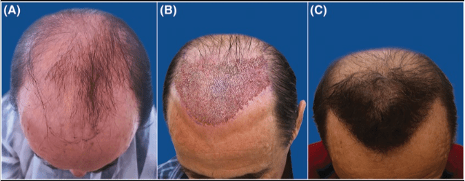 (A) Patient pre-surgery. (B) Patient immediately after grafting the frontal scalp area. (C) Patient 9 months post-surgery. *