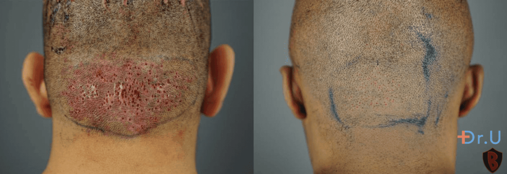 Hispanic male patient seen with tiny wounds secondary to FUE procedure, taken immediately after surgery for papular AKN (left). African male patient with tiny wounds secondary to FUE procedure, taken immediately after surgery for papular AKN (right). 