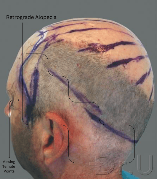 Some of the characteristics of retrograde alopecia are hair loss at the nape and temples. Some of the characteristics of retrograde alopecia are hair loss at the nape and temples.