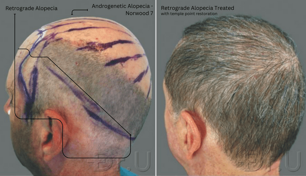 The patient’s temple points were craftily restored. NW 7 Patient with retrograde alopecia and temple loss before and after FUE hair restoration using head, beard, and body hair transplants