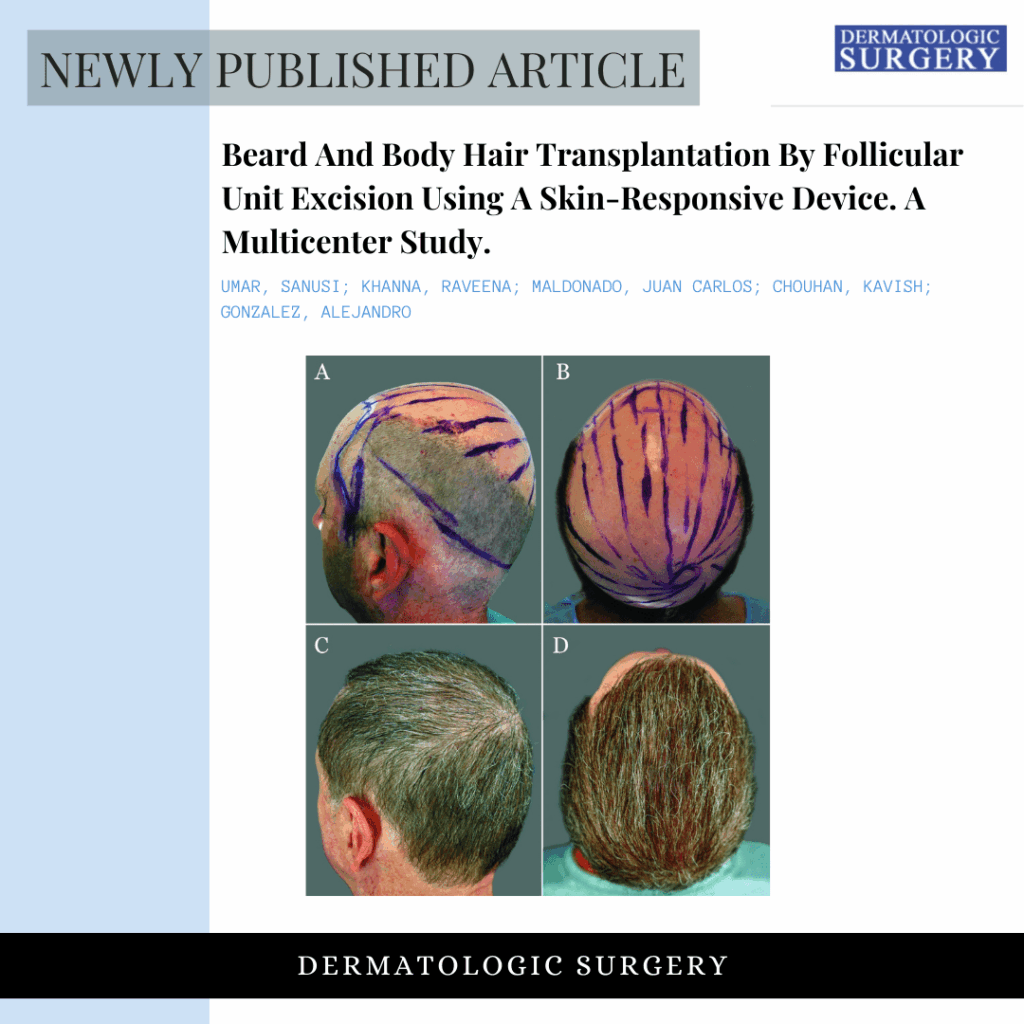 Read this study on body hair transplant (BHT) by Dr. U Hair and Skin published in the Dermatologic Surgery.