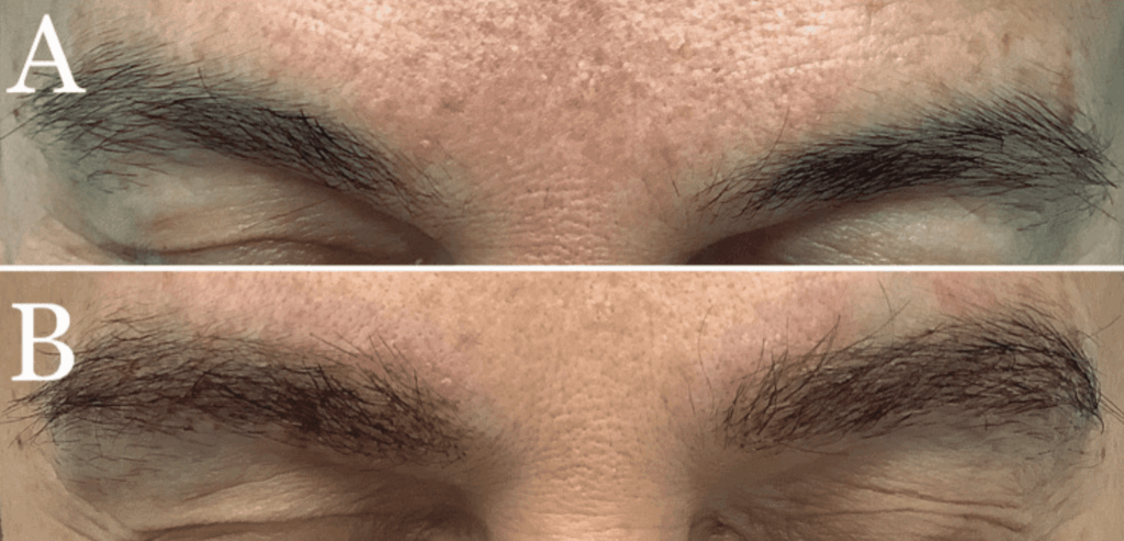 Long-Hair FUE allows an immediate “preview” of the results. This woman already has thicker and more defined eyebrows shortly after her procedure. Long-Hair FUE allows an immediate “preview” of the results. This woman already has thicker and more defined eyebrows shortly after her procedure.
