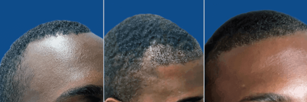 While patients with Afro-hair are still deemed challenging hair transplant patients, Dr. U Hair and Skin clinic successfully performs Afro - FUE surgeries, without even needing to shave the donor area. While patients with Afro-hair are still deemed challenging hair transplant patients, Dr. U Hair and Skin clinic successfully performs Afro - FUE surgeries, without even needing to shave the donor area.