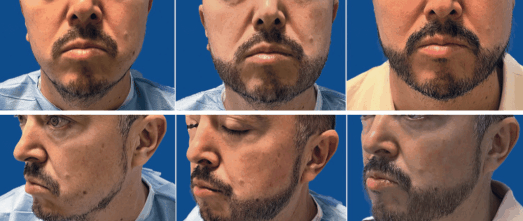 Front and oblique views of a Hispanic patient before his beard restoration surgery with long shafts (left), immediately after (center), and 10 days post-surgery (right). Front and oblique views of a Hispanic patient before his beard restoration surgery with long shafts (left), immediately after (center), and 10 days post-surgery (right).