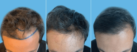 Left to right: Patient before long-hair FUE; Patient forty-eight hours post-surgery. Copyright ©2021. Dove Medical Press; Patient three years after surgery. Left to right: Patient before long-hair FUE; Patient forty-eight hours post-surgery. Copyright ©2021. Dove Medical Press; Patient three years after surgery.