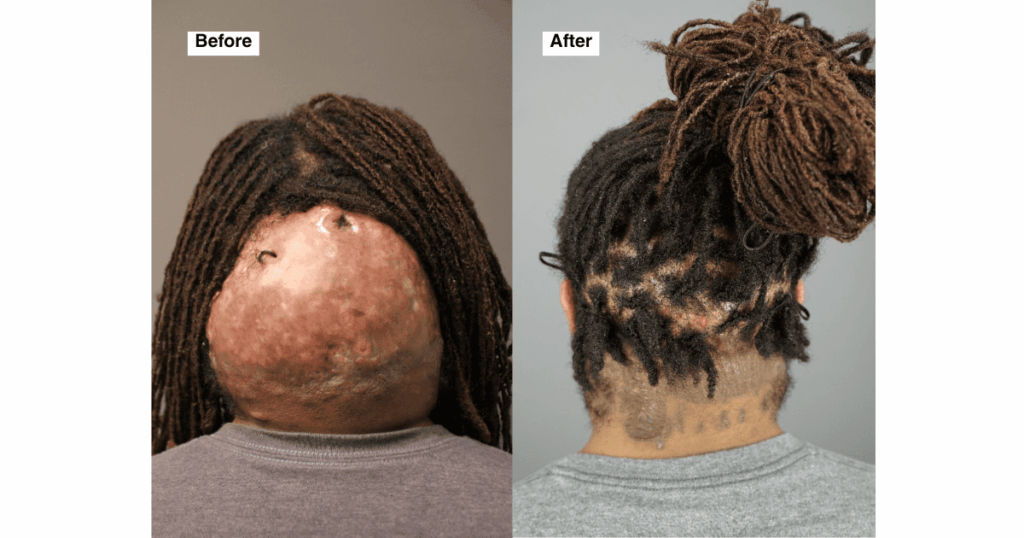 Side-by-side comparison showing Fred’s back of the scalp before surgery with a large Acne Keloidalis Nuchae (AKN) mass, and after surgery with a smooth, healed scar and natural hairline restoration
