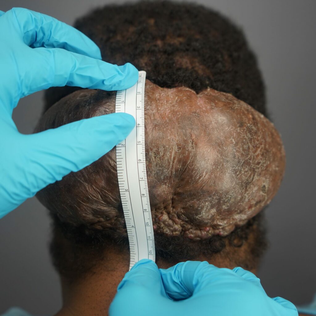 Measurement of Adrian’s large Acne Keloidalis Nuchae (AKN) located behind his head.