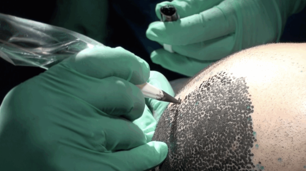 Scalp micropigmentation procedure being performed on a male patient.
