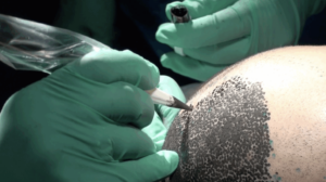 Scalp micropigmentation procedure being performed on a male patient.
