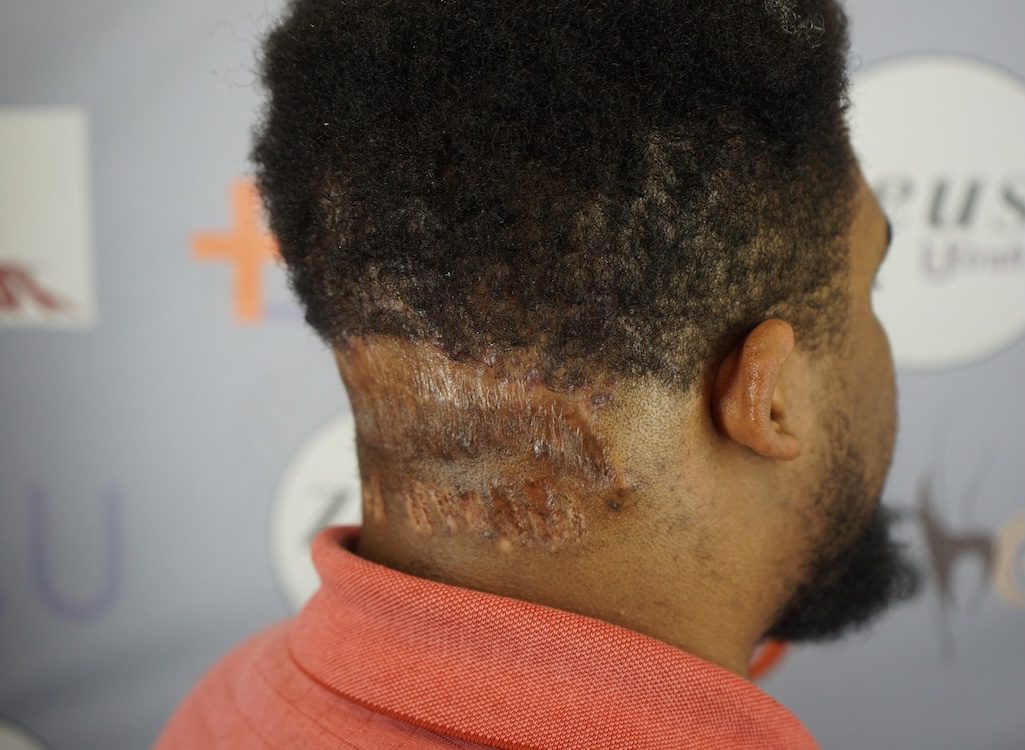 Adrian’s results from AKN removal surgery. Minimal scarring on the back right of his head.