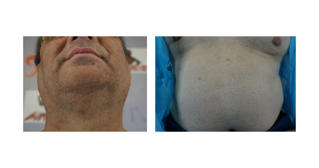 Jon’s beard and stomach areas fully healed after body hair extraction. Thanks to the UGraft Zeus system, both donor sites display minimal scarring following the procedure.
