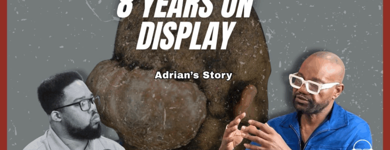 Eight Years On Display: Adrian’s Hidden Struggles with Acne Keloidalis Nuchae