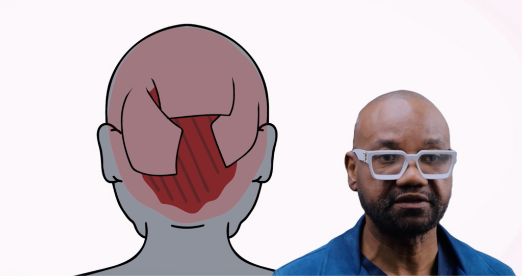 Dr. Umar explains that the trauma caused by the balloon expansion method can cause inflammation that eventually creates new Folliculitis Decalvans.

