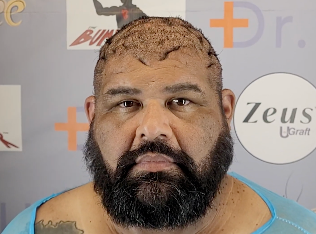 John came into the Bumpinator clinic with complex current scalp conditions that looks like bumps and draining boils