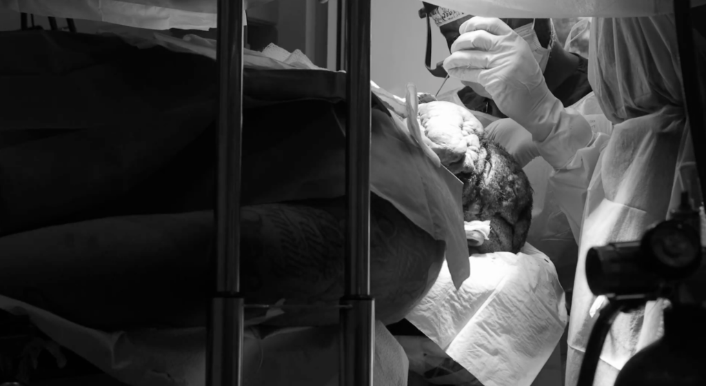 John is now undergoing the surgical removal of his scalp lesions, lead by Dr. Sanusi Umar, who is also known as the Bumpinator.