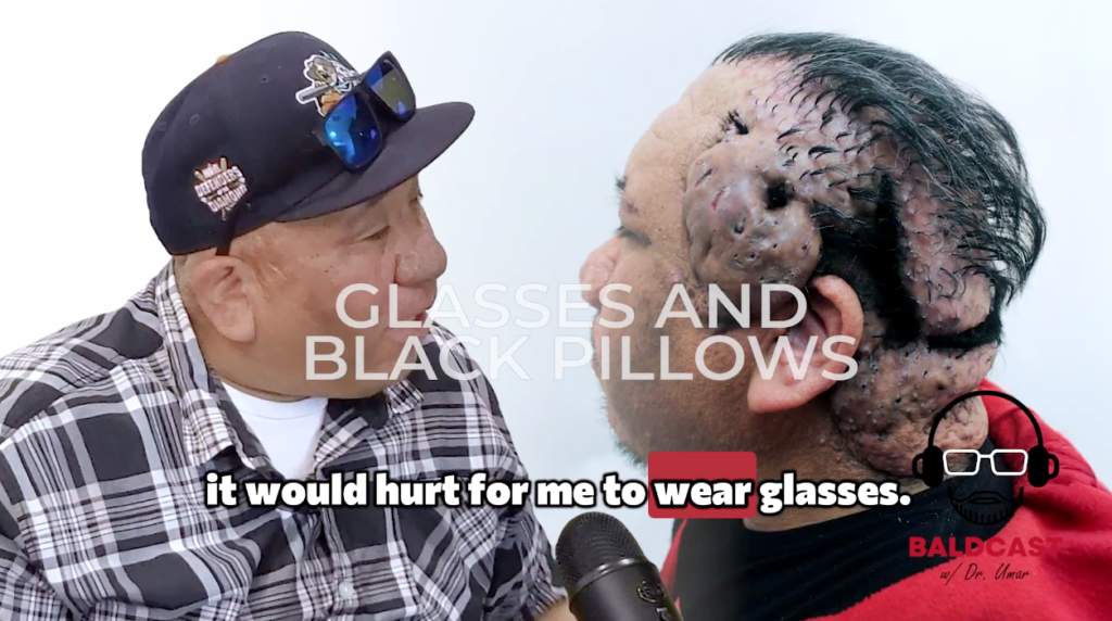 When his scalp disorder started to worsen, Robert could no longer wear any type of glasses, whether prescriptions or sunglasses. 
