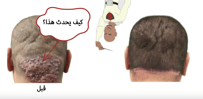 What one person may misunderstand as small razor bumps on the back of the head, can potentially be AKN, and can grow to this stage if left untreated. It is important to understand how Acne Keloidalis Nuchae develops as a patient, as this can help you understand the procedure and steps required to remove AKN better.